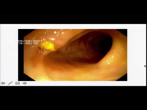 Vídeo: Perforación Gastrointestinal: Causas, Síntomas Y Diagnóstico