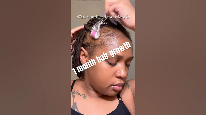 1 month Hair growth journey! #minoxidil #hairgrowth #hairgrowthchallange #baldinghair #hairloss