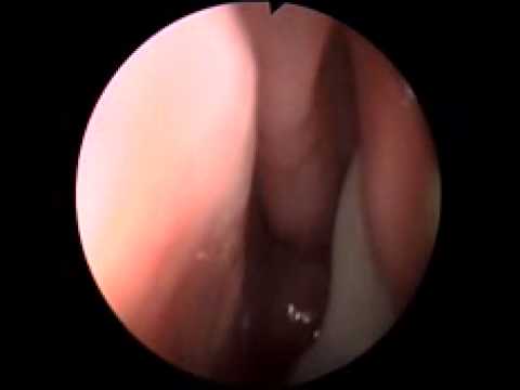 pus in left middle meatus