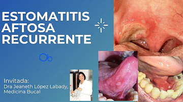 ¿Cómo se trata la estomatitis de la lengua?