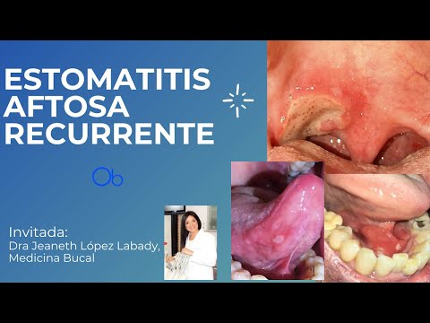 Vídeo: Estomatitis En Nens: Causes, Símptomes, Tractament