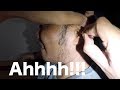 Removing Man's Hard & Stiff Earwax Blockage- He Almost Gave Up