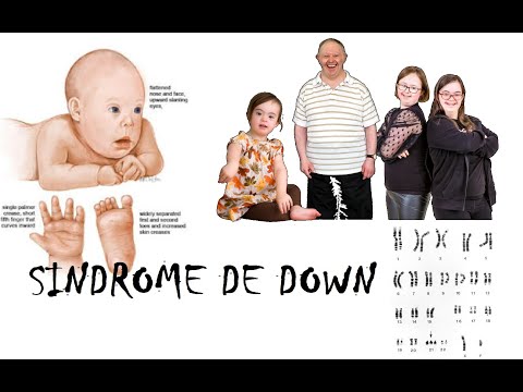 Síndrome de Down