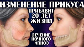 Изменение прикуса прибавляет 20 лет жизни. Лечение ночного апноэ. 3 серия.