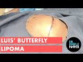 Luis' Butterfly Lipoma