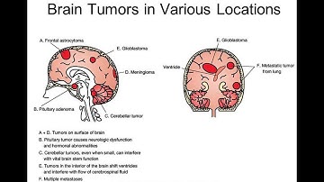 Brain Tumors: Signs and Symptoms
