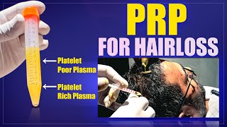PRP Hair Treatment In Bangalore | NEW ROOTS |
