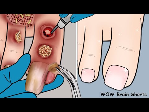 [ASMR] Remove warts