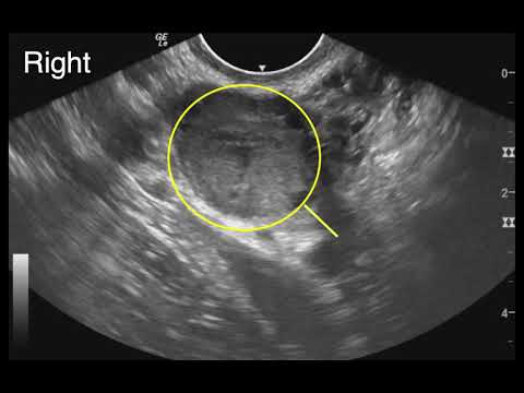 Early Pregnancy, Light Vaginal Bleeding 