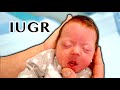 RARE INTRAUTERINE GROWTH RESTRICTION (IUGR) | Dr  Paul