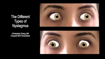 Types of Nystagmus Due to BPPV Vertigo (What it Looks Like, Which Side, & Which Maneuver?)