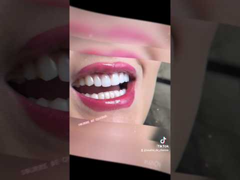   عدسات الاسنان اكسبلور    تجميل تيك توك