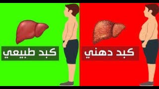 علاج الكبد الدهني - اعراض الكبد الدهني | اسباب الكبد الدهني