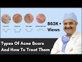 Types Of Acne Scars And How To Treat Them | ClearSkin, Pune | (In HINDI)