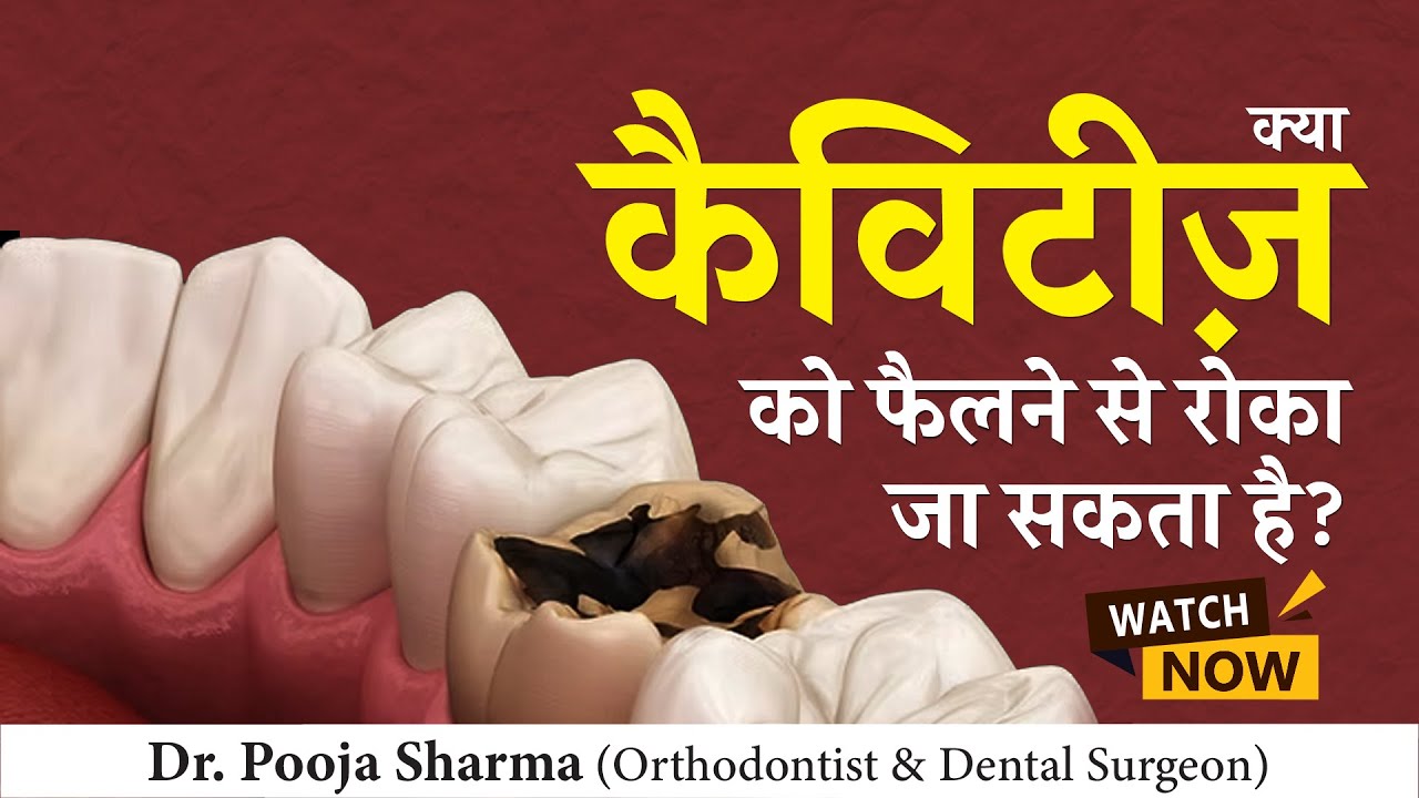 क्या कैविटीज़ को फैलने से रोका जा सकता है?  Dental Cavity Treatment In Agra, UP - Dr Pooja Sharma