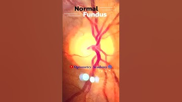 Normal fundus | Normal Retina | Smartphone Fundus Videography | Fundus Photography | Short Video 258
