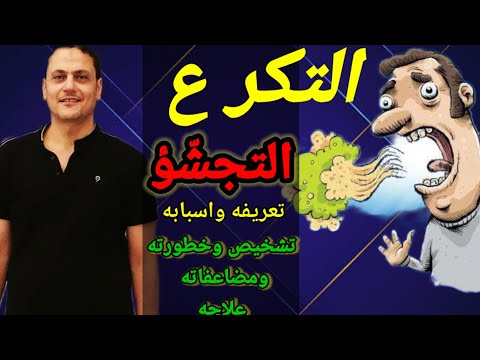 التكرع او التجش ؤ أسباب أعراض علاج دكتور محمود الشربيني