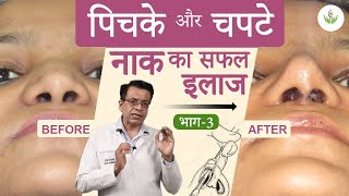 पिचकी और चपटी नाक का सफल इलाज (भाग - 3) | केयर वेल मेडिकल सेंटर screenshot 2