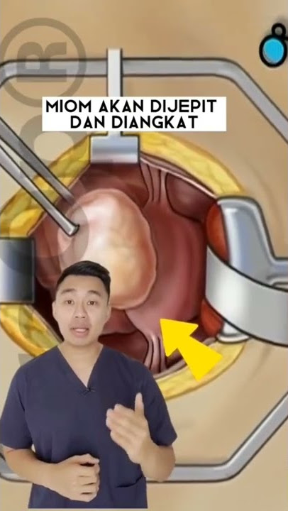 Cara operasi miom #miom #operasi #tipskesehatan #kesehatanwanita #viral #tipspromil