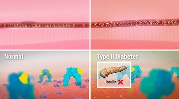 Insulin Resistance in Type 2 Diabetes
