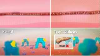 Insulin Resistance in Type 2 Diabetes