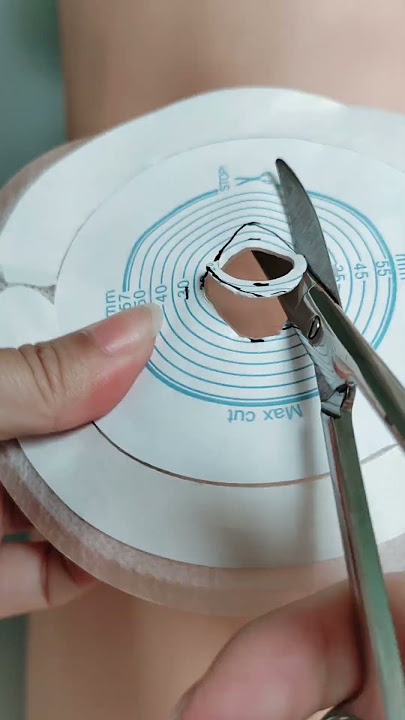 The shape of the stoma is not round, oval and irregular, how to cut the stoma bag