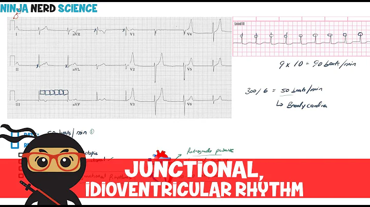 Rate and Rhythm | Junctional and Idioventricular Rhythm
