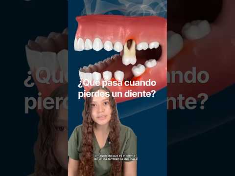 Qué pasa cuando se pierde un diente 🦷  #diente #mexicali #implantes #endodoncia #dental #mexicali