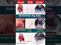 Normal Vs abnormal Echo & ECG🫀 #echocardiography