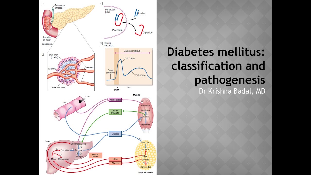 Diabetes Mellitus part I: Classification and pathogenesis - YouTube
