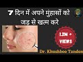 7 दिन में Pimples / Acne को जड़ से खत्म करें || Home Remedies For Pimples/Acne (in Hindi)