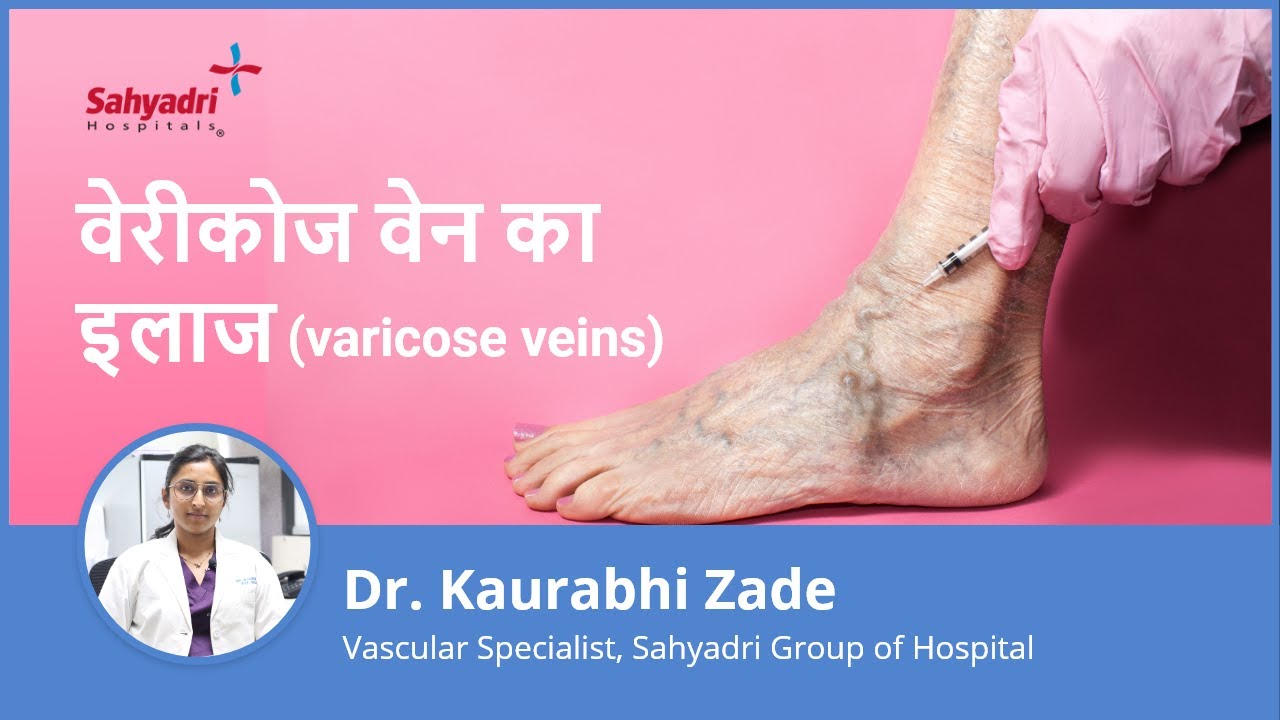 Varicose Veins - Treatment and Prevention (Videos)