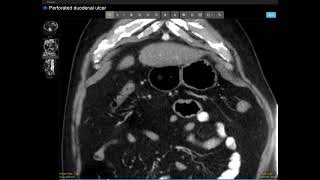 perforated duodenal ulcer