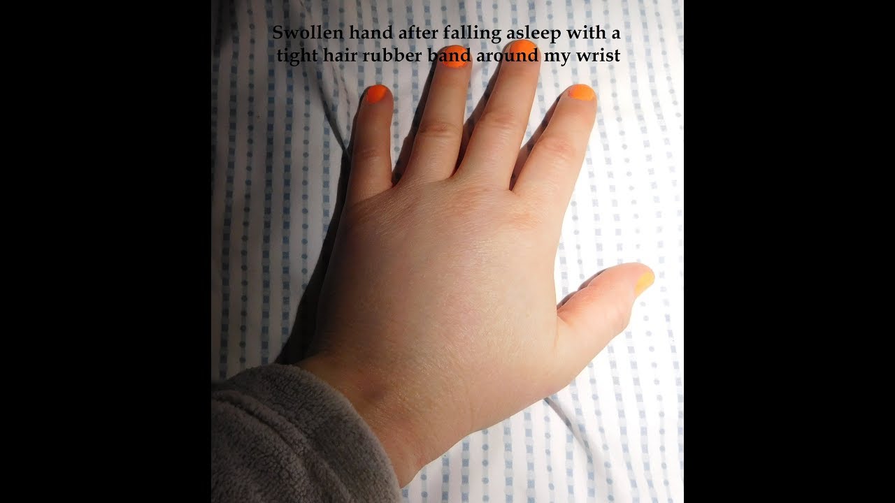 Swollen Hand from Accidental Tourniquet (Hair Elastic) YouTube