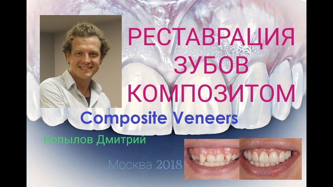 Композитные виниры. Трансформация клыков в резцы. Виниры до и после. Composite veneers.