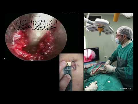 استئصال الانزلاق الغضروفي القطني بالمنظار دكتور أحمد الغيطي استشاري جراحة المخ والاعصاب