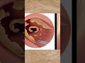 Ear treatment ASMR animation #asmr #animation #Ear #treatment #satisf...