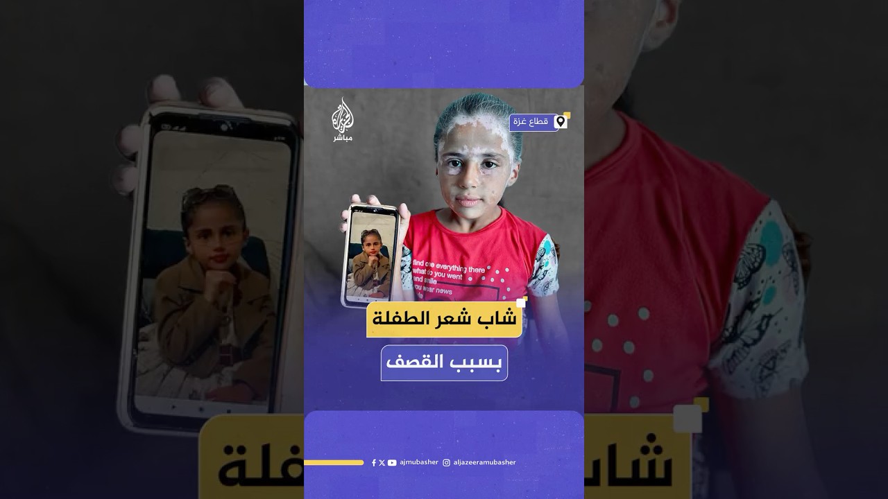 شاب شعرها.. طفلة فلسطينية أصابها مرض البهاق نتيجة الخوف من القصف الإسرائيلي