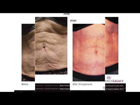 Venus Legacy™ Before & After Photos  Abdomen