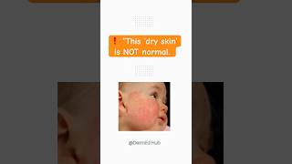 ❗ “This ‘dry skin’ is NOT normal…#atopicdermatitis #skincare #beautytips #skincareroutine