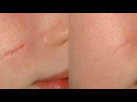 العلاج السحري لإزالة اثار الحروق والجروح القديمه والحديثه