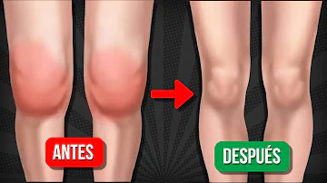 ¿Cómo desinflamar la grasa de la rodilla?