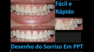 Planejamento Do Sorriso - Simulação De Laminados Em Power Point