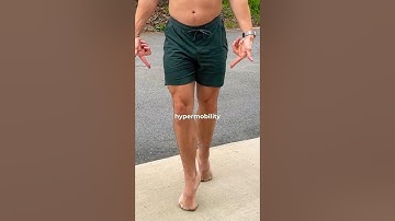 Hypermobiliteit heeft niet alleen invloed op gewrichten #shorts