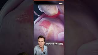 A New Way to Fix a Torn Shoulder Tendon  #ShoulderPain #RotatorCuffTear #Orthopedics #MedohHealth screenshot 3