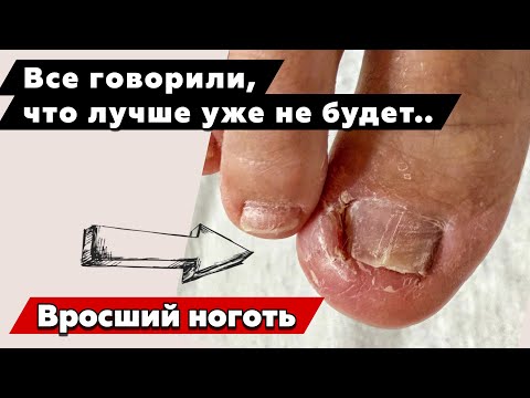Как остановить постоянное врастание ногтя