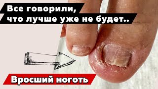 Как остановить постоянное врастание ногтя
