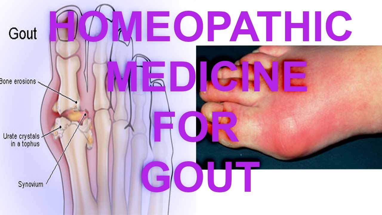 Gout गठीया Homeopathy Hindi Gout ka ilaj Gouty Arthritis