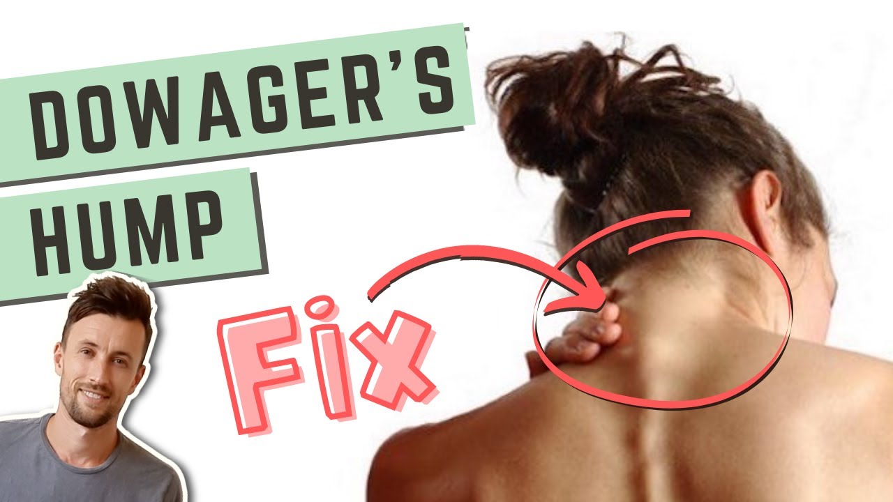 Dowager's Hump: 2 MUST-DO Things to Fix a Neck Hump 