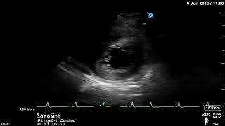 Chapter 7 - Hyperdynamic left ventricle PSAX view